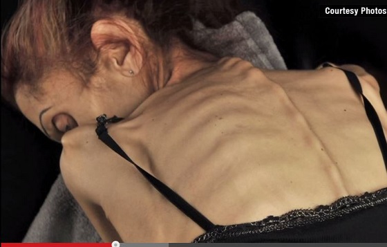 【拒食症】身長170cm体重18キロ ― 米国人女優を「死のダイエット」に駆り立てたものとは？の画像2