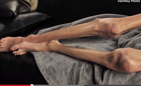 【拒食症】身長170cm体重18キロ ― 米国人女優を「死のダイエット」に駆り立てたものとは？の画像3