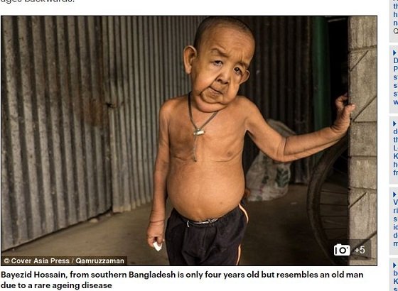 難病「プロジェリア症候群」による4歳なのに80歳の風貌！ 差別と貧困に喘ぐリアル「ベンジャミン・バトン」の過酷な人生＝バングラデシュの画像1