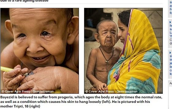 難病「プロジェリア症候群」による4歳なのに80歳の風貌！ 差別と貧困に喘ぐリアル「ベンジャミン・バトン」の過酷な人生＝バングラデシュの画像2