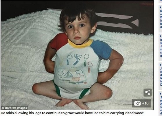 下半身はないがアクティブな青年がイケメンすぎる！ 恋愛したくても肛門が問題で… 奇病「仙骨発育不全」との闘いの画像1