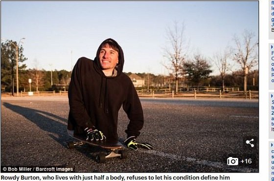 下半身はないがアクティブな青年がイケメンすぎる！ 恋愛したくても肛門が問題で… 奇病「仙骨発育不全」との闘いの画像2