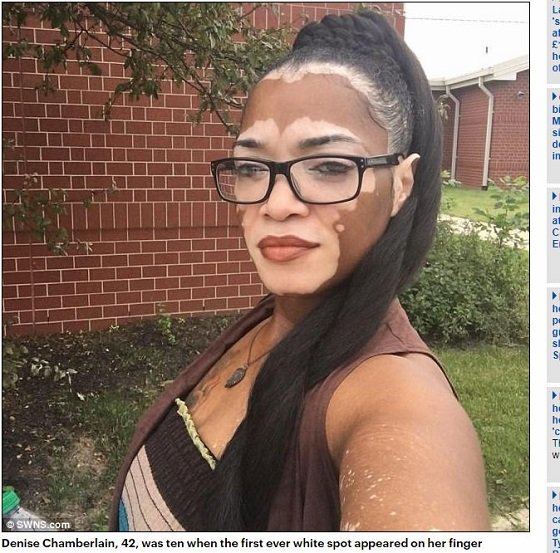 【奇病】全身白まだらの黒人美女が衝撃のすっぴん姿を初公開！ 厚化粧を捨てて自分を認めるため… 尋常性白斑に立ち向かう！の画像1