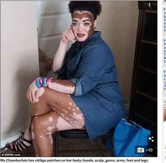 【奇病】全身白まだらの黒人美女が衝撃のすっぴん姿を初公開！ 厚化粧を捨てて自分を認めるため… 尋常性白斑に立ち向かう！の画像2