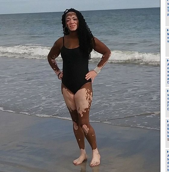 【奇病】全身白まだらの黒人美女が衝撃のすっぴん姿を初公開！ 厚化粧を捨てて自分を認めるため… 尋常性白斑に立ち向かう！の画像3