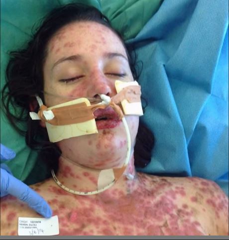 「スティーブンス・ジョンソン症候群」薬の副作用で美少女の姿が変わり果てる悲劇!!の画像2