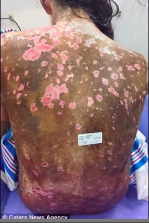 「スティーブンス・ジョンソン症候群」薬の副作用で美少女の姿が変わり果てる悲劇!!の画像3