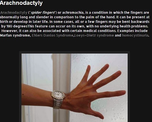 マルファン症候群 ― 天才音楽家の超絶技巧を生んだ病の画像1