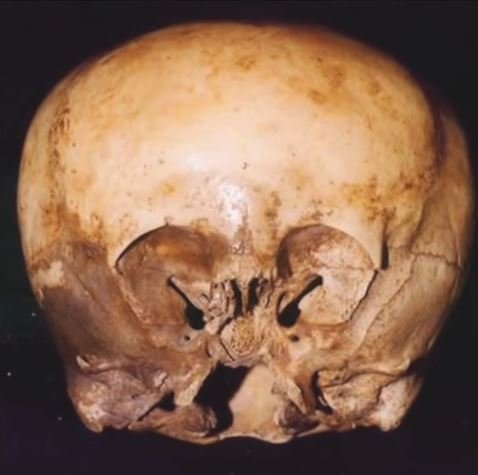 「スターチャイルド頭蓋骨」の謎とは？ DNA鑑定で非人間、宇宙人とのハイブリッドか？の画像1