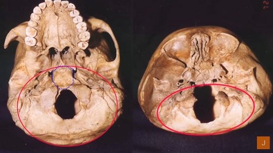 「スターチャイルド頭蓋骨」の謎とは？ DNA鑑定で非人間、宇宙人とのハイブリッドか？の画像2