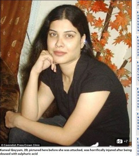 【アシッドアタック】女友だちから妬まれた美女が、酸をかけられ顔面崩壊 → 10年かけて人生を取り戻すまでの画像1