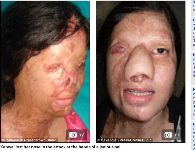 【アシッドアタック】女友だちから妬まれた美女が、酸をかけられ顔面崩壊 → 10年かけて人生を取り戻すまでの画像2