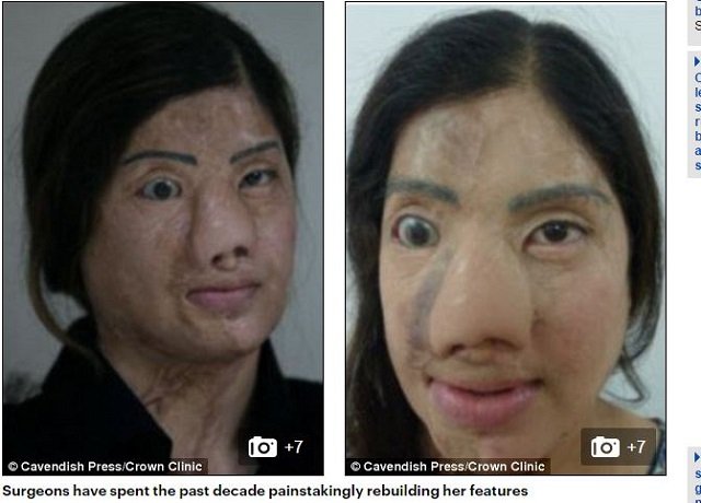 【アシッドアタック】女友だちから妬まれた美女が、酸をかけられ顔面崩壊 → 10年かけて人生を取り戻すまでの画像3