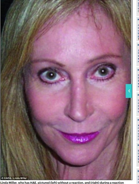 HAE ― 医師も困惑するほど顔が変形する謎の遺伝病とは？の画像1