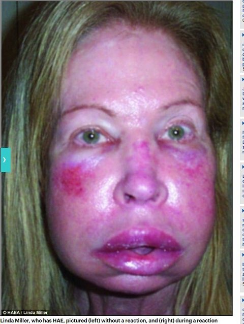 HAE ― 医師も困惑するほど顔が変形する謎の遺伝病とは？の画像2