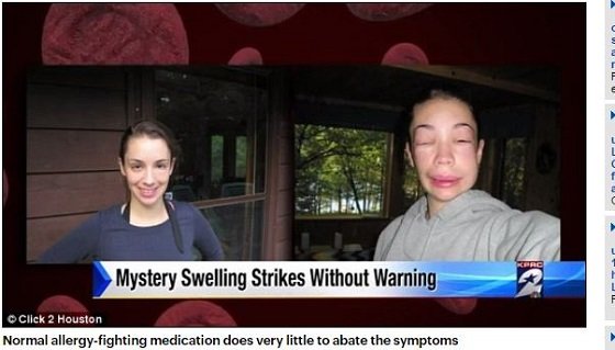 HAE ― 医師も困惑するほど顔が変形する謎の遺伝病とは？の画像4