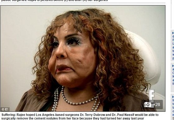 顔面にセメント注入で整形失敗、コブコブの怪物に… 衝撃的なアメリカの整形手術3例の画像1