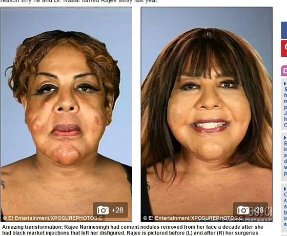 顔面にセメント注入で整形失敗、コブコブの怪物に… 衝撃的なアメリカの整形手術3例の画像3