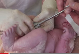 赤ちゃんの「へその緒」切断を3分遅らせるだけで発達が促進される？の画像1