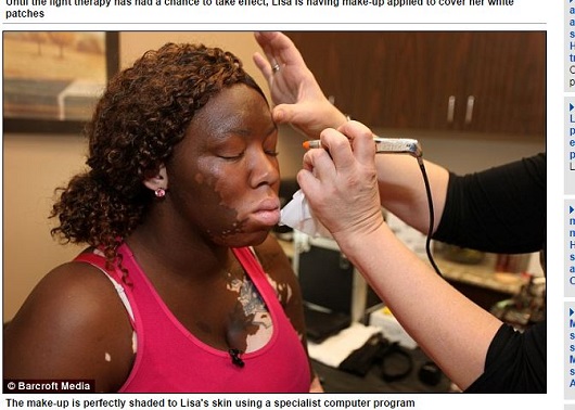 部分的に白人になった黒人女性を襲った苦難とは!? 「シロナマズ」羅患による壮絶人生の画像2