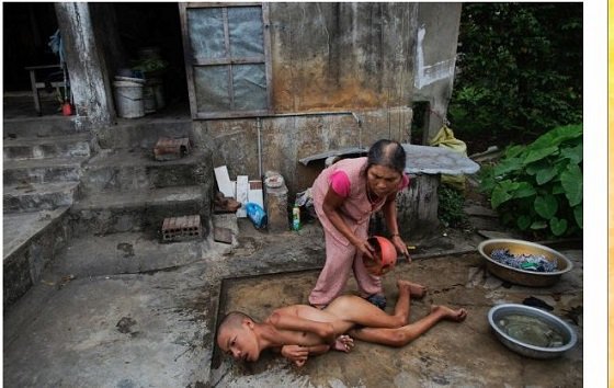 ベトナム「枯葉剤」の被害は終わっていなかった！ 今も苦しむ子どもたちの写真6選とモンサント社の大罪の画像2