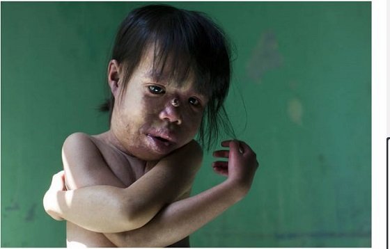 ベトナム「枯葉剤」の被害は終わっていなかった！ 今も苦しむ子どもたちの写真6選とモンサント社の大罪の画像6