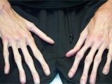 マルファン症候群 ー 天才音楽家の超絶技巧を生んだ病