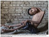 【奇病】首がグニャリと180度曲がってしまった少年=インド  母親にも呪われ続けた壮絶人生