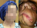 【閲覧注意】顔面ドロドロ女、顔を“取り替えて”超絶美女に大変身！ 手術映像が壮絶すぎる!!