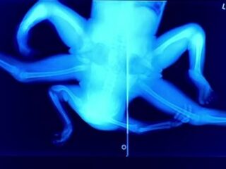 4本の手と4本の足 ― インド人幼女「結合双生児」のドキュメンタリー