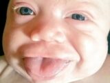 口からニョキニョキ、舌だけが2倍の速さで成長する奇病 ― ベックウィズ・ヴィーデマン症候群