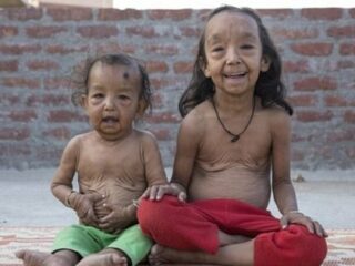 老人として生まれた幼児 ― 「早老症」と「皮膚弛緩症」併発という残酷すぎる現実＝インド