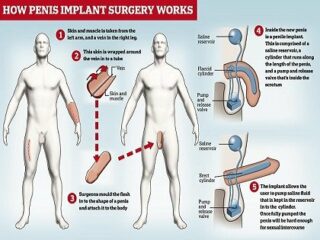 ペニスなしで生まれた男（44）が“バイオニックペニス”で童貞卒業！ 早くも“悟りの境地”に到達「私は勃ち直った。泥酔でも勃ち上がる」