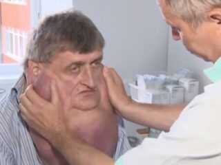 顎が胸まで伸びた男！ 重さ6kg完全切除へ＝スロバキア