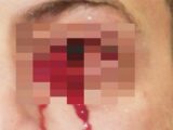 血の涙を流す謎の「ヘモラクリア」 1時間以上「血の涙」を流し続けた男の謎、鼻をつまむと耳から血が出ることも