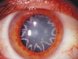 瞳にキラキラの星型模様が出た男!! 原因は恋ではなく……驚愕の症例報告!