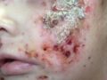 水の汚染が原因で恐怖の皮膚病が流行？ 政府は否定・隠蔽で、カナダ先住民がブチギレ！