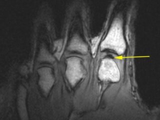 「関節がポキポキ鳴る理由」がついに判明!!　長年の論争に終止符！