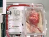 死んだ心臓を“生き返らせて”移植成功! ドナー不足を解消する驚愕の新技術登場!!=豪