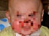 愛する我が子がチャッキーになっていく…! 恐怖の皮膚疾患「EBウイルス」と闘う子どもたち