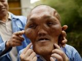 細胞増殖が止まらない顔面、歯が粉砕され耳も聞こえなく…! “エイリアン顔”の男、支援を訴える=中国
