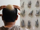 禿げた時のための「ヘアバンク」1年以内に開始! 頭皮細胞を保存&培養… 格安特価でハゲ絶滅へ「人生の保険だ」