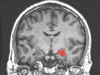 手術で心の中が見えるようになった女性 ― 人間は機能を失うと「超能力」が開花する！