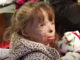 放火で家族を失い、重度の火傷を負った少女が「世界中からのクリスマスカード」を希望