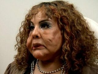 顔面にセメント注入で整形失敗、コブコブの怪物に… 衝撃的なアメリカの整形手術3例