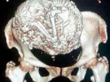 92歳老婆の腹から「ミイラ化した巨大胎児」 ー 剥がせぬミイラに医師が出した答え= チリ