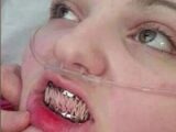 エーラス・ダンロス症候群 ― 身体がバラバラになる少女、口も縫い合わせる=イギリス