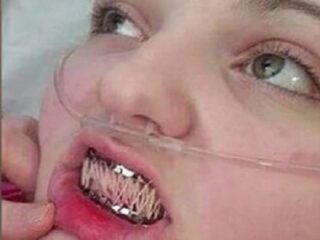 エーラス・ダンロス症候群 ― 身体がバラバラになる少女は口も縫い合わせる＝イギリス