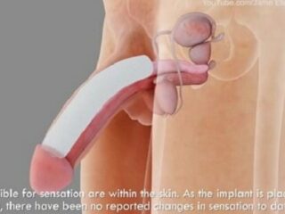 男性器巨大化手術の需要が世界的に高まる　太さ円周34％の増大も、壊死するリスク