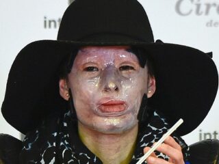 33歳美人女性の顔に硫酸「すべてが灰色になった」 ―  アシッドアタックの惨劇＝コロンビア
